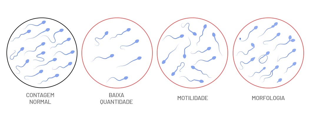Azoospermia: do diagnóstico ao tratamento